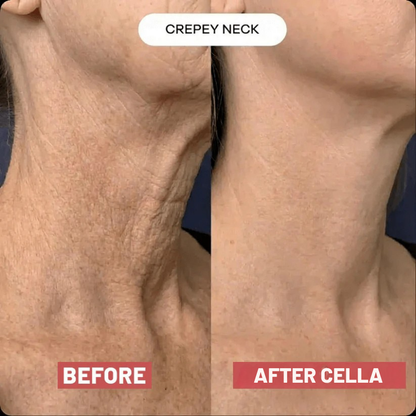 Cella V-Lift™ Neck Restore Device