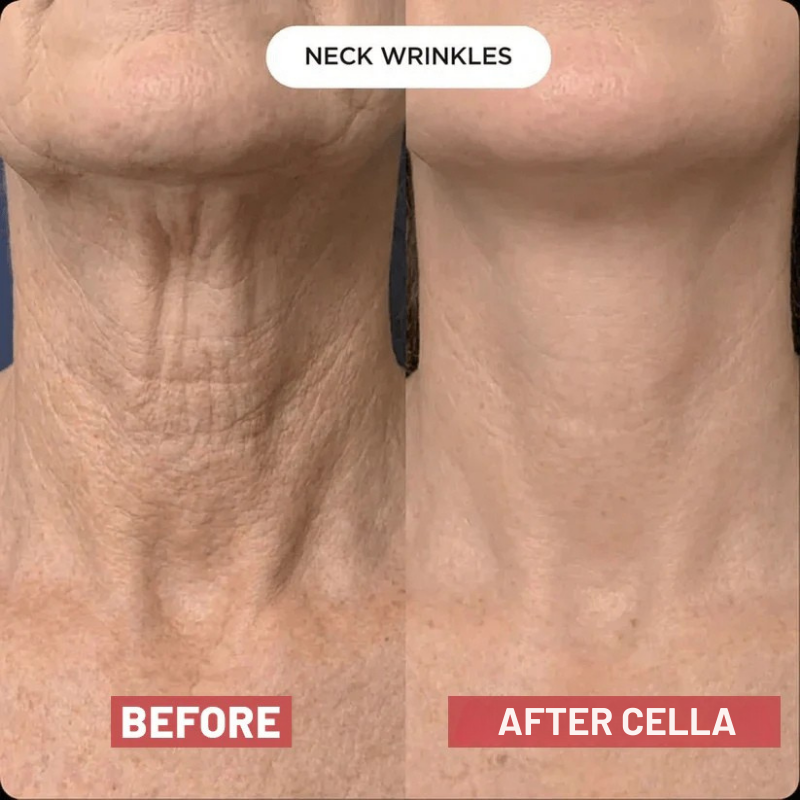 Cella V-Lift™ Neck Restore Device