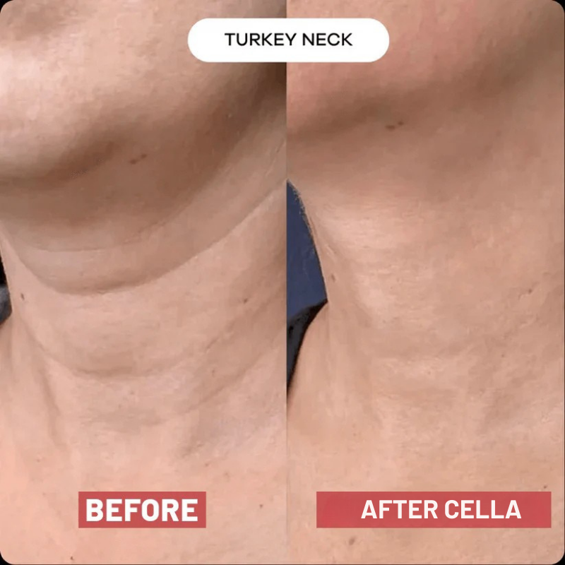 Cella V-Lift™ Neck Restore Device