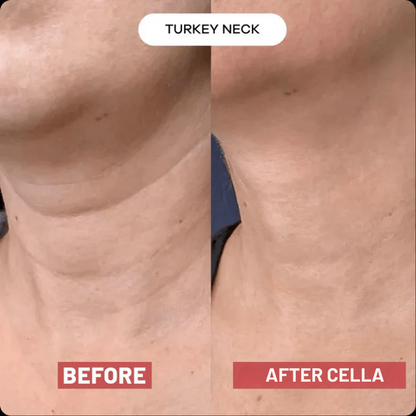 Cella V-Lift™ Neck Restore Device
